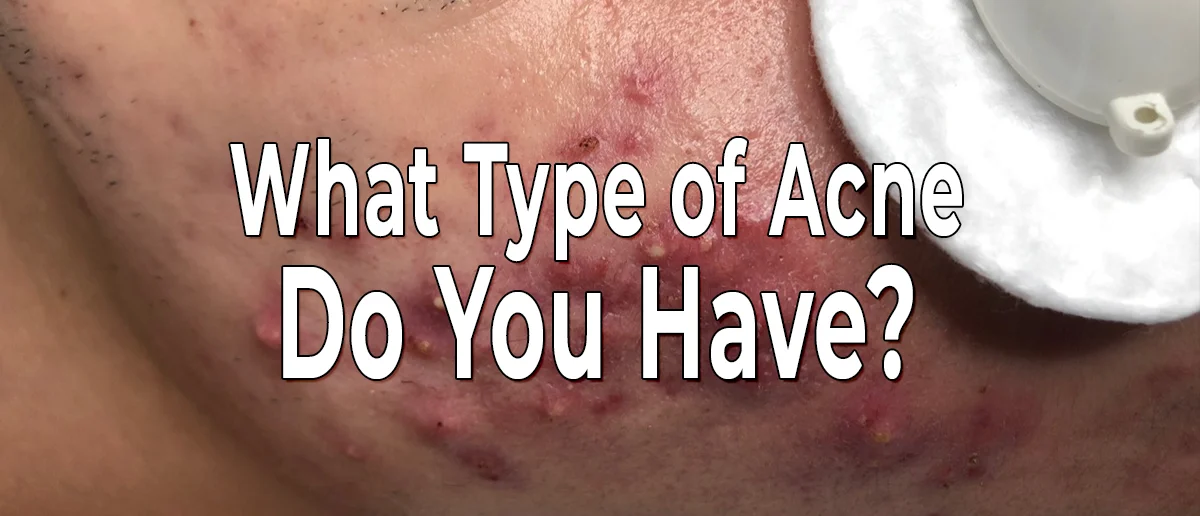 What Type Of Acne Do You Have?